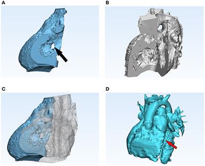 Use of 3D Models in the Surgical Decision-Making Process in a Case of Double-Outlet Right Ventricle With Multiple Ventricular Septal Defects